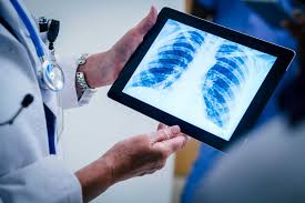 Chest X-Ray