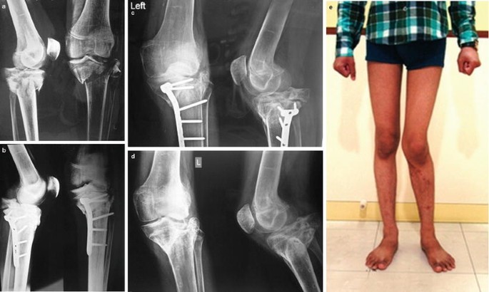 Paediatric Orthopaedics Deformity Correction Clubfoot