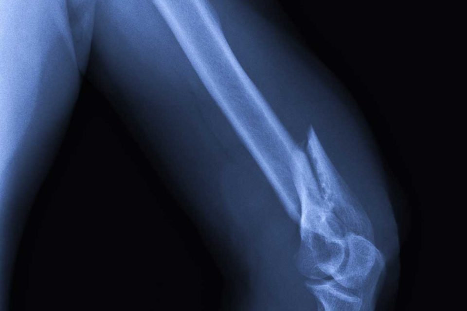 Fracture and Trauma Care plaster POP titanium plates screws