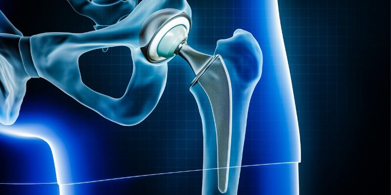 Joint Replacement TKR THR partial knee hip