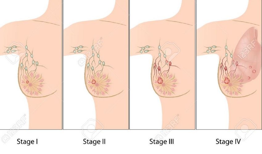 Stages of Breast Cancer