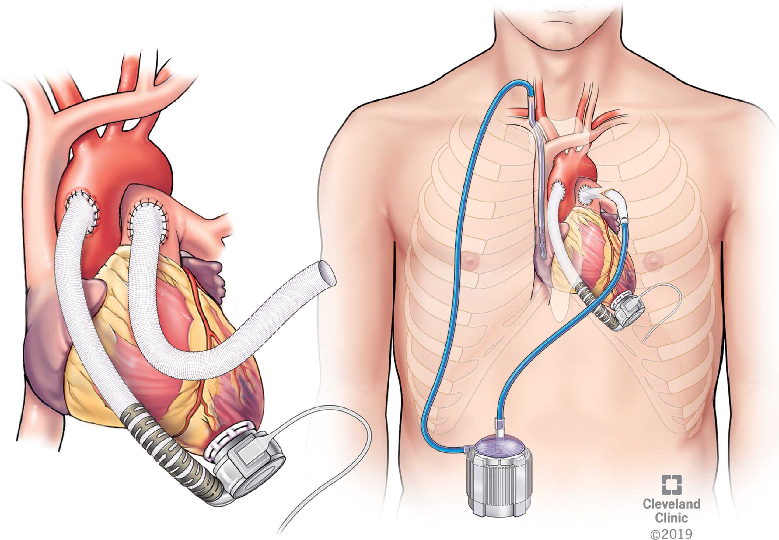ECMO and LVAD support
