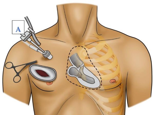 Minimally invasive cardiac surgery
