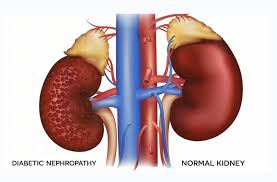 Diabetic kidney disease treatment Delhi
