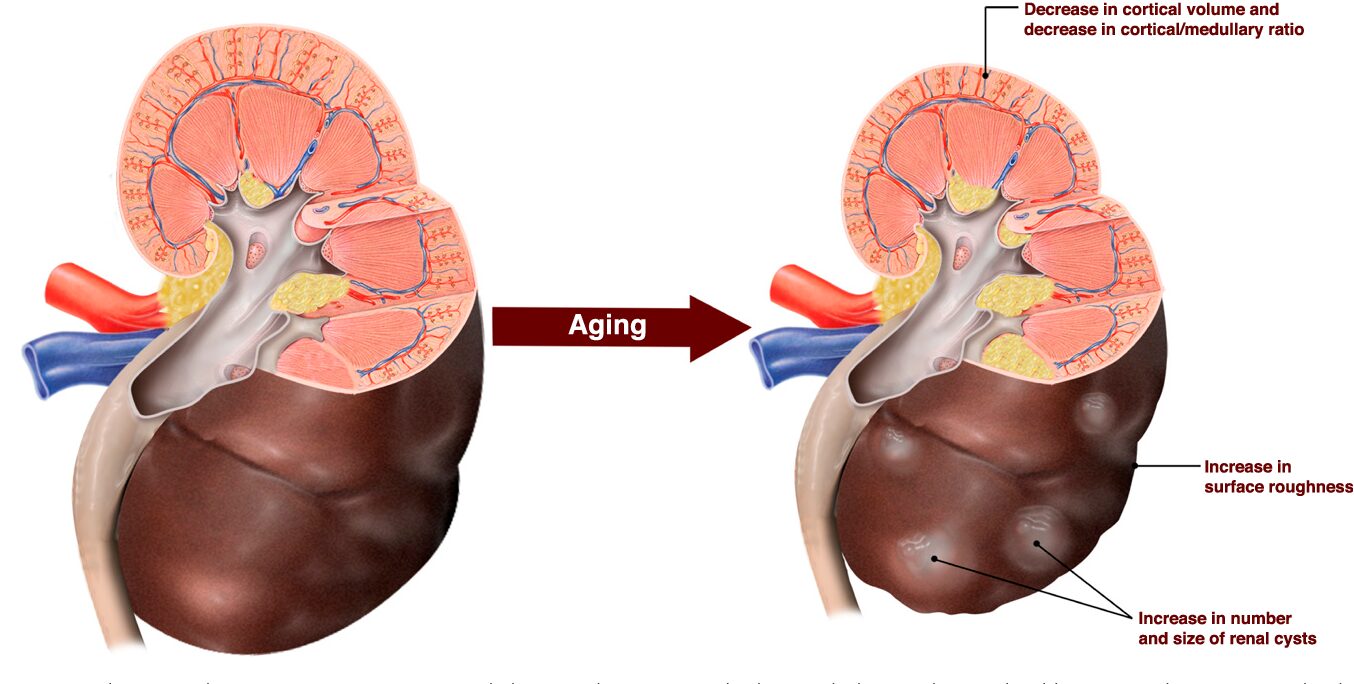 Kidney care for elderly patients Delhi