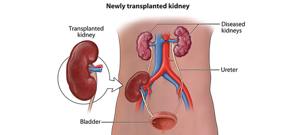 Kidney transplant specialist Delhi